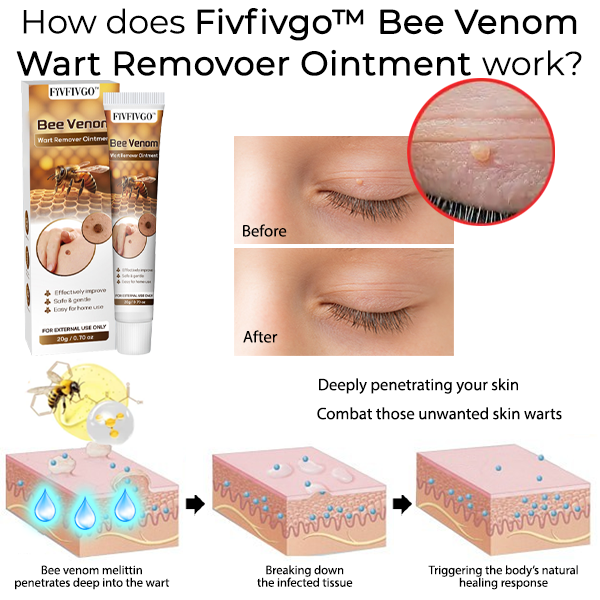 Oveallgo™ Bee Venom Wart Remover Ointment